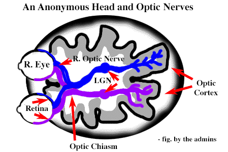 Anonymous Head and Optic Nerves