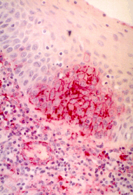 Damage to connective tissue.