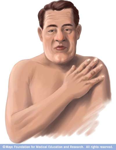 acromegaly